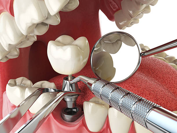 Best Emergency Treatment for Dental Infections or Abscesses in St Marys, OH